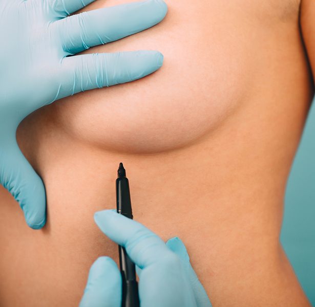 10 things to know before undergoing cosmetic breast surgery