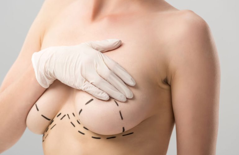 Mastopexy (Breast Lift)