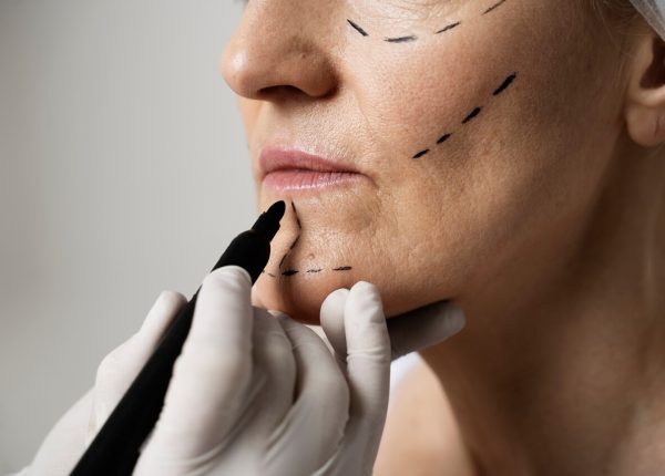 Facelift